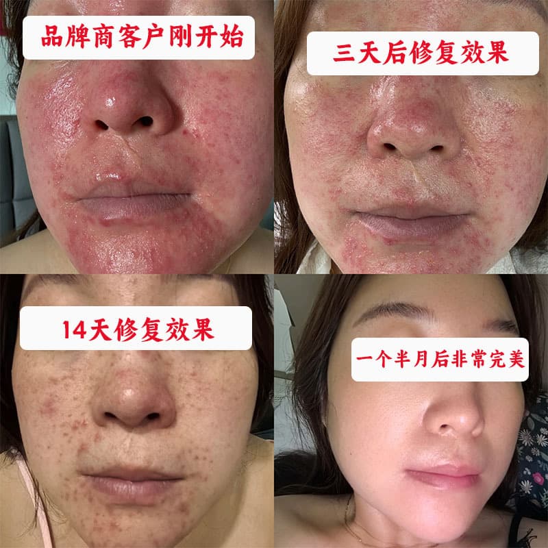 Hormone-induced facial repair mask, specifically designed for hormone-induced facial redness, swelling, itching, and sensitive skin.