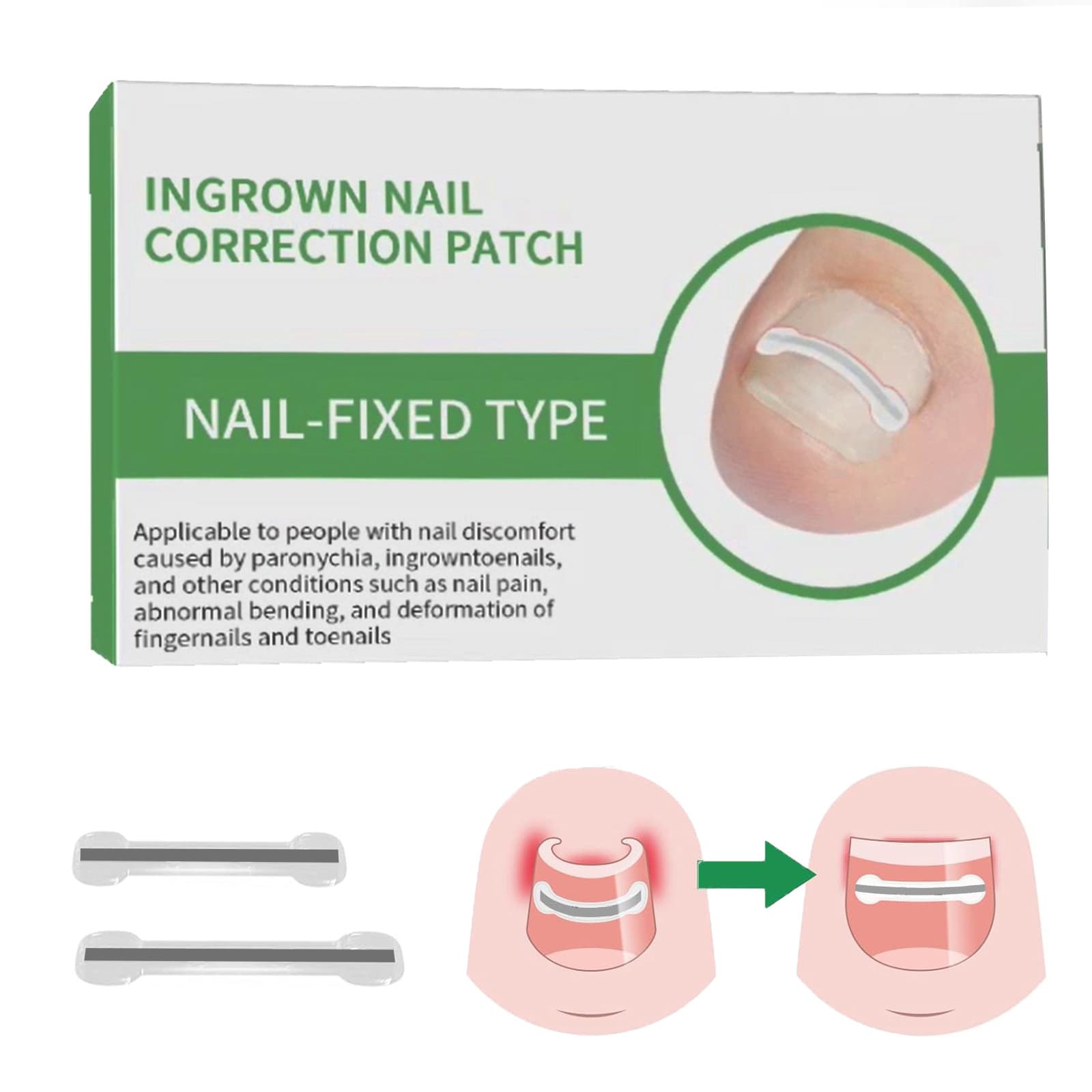 Nickel Titanium Alloy Bone Patch Toenail Correction Sticker for Ingrown Nail