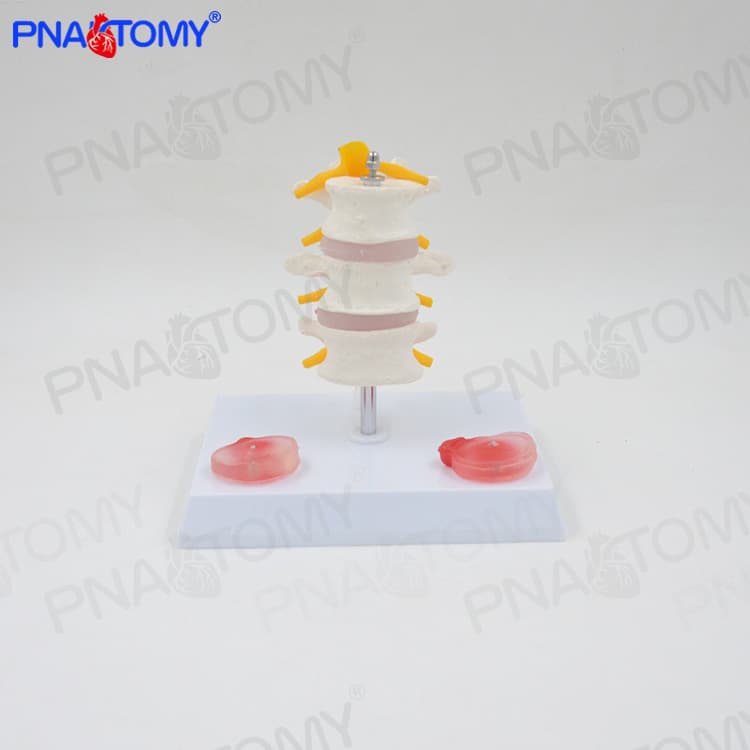 Human Three-Segment Lumbar Vertebrae with Spinal Nerves / Herniated Intervertebral Disc Skeleton Model for Medical Orthopedics, Pain Department, and Bone Setting