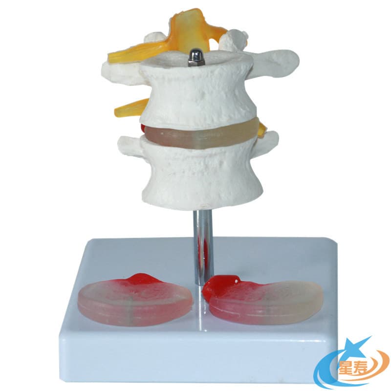 Human two-section lumbar vertebrae with spinal neuropathy intervertebral disc skeleton model for medical teaching orthopedics pain department bone setting