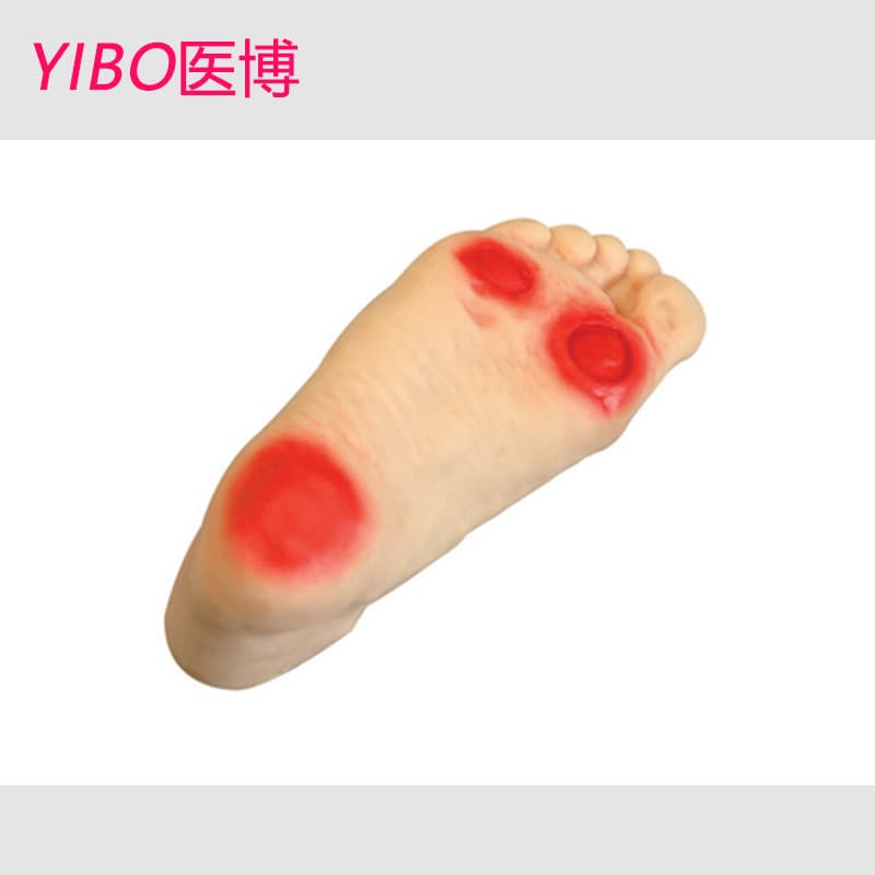 BIX-HS19 Advanced Diabetic Foot Care Model Foot Training Diabetic Foot Lesion Model