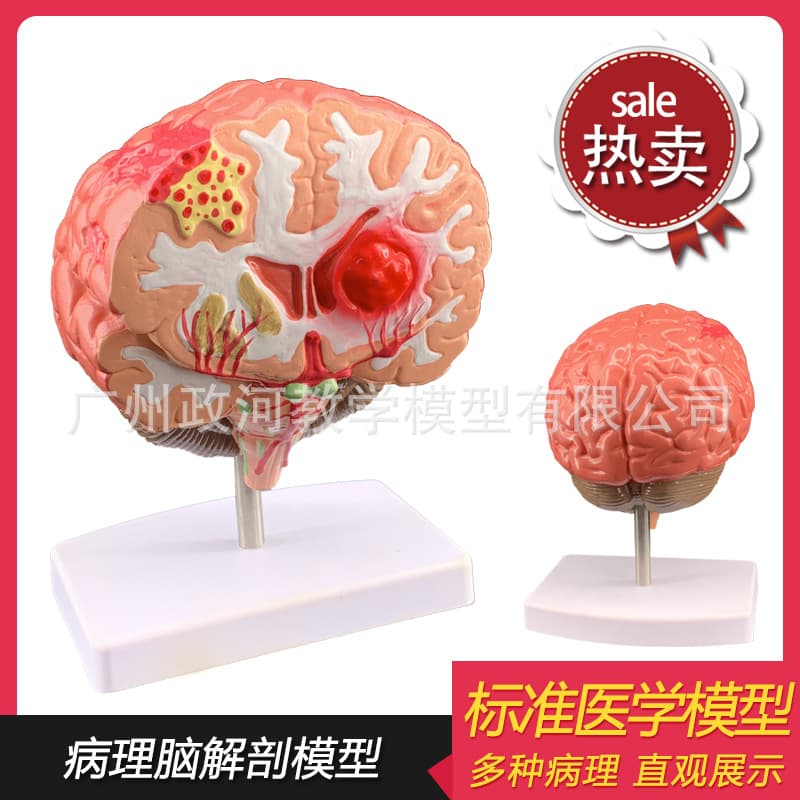 Simulated Human Brain Disease Model, Brain Anatomy, Neurosurgery, Brain Pathology, Brain Lesion Model