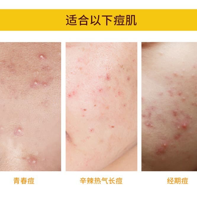 Amazon Cross-Border Best Seller Acne Patches Hydrocolloid Cover Waterproof Portable Shaped Colorful Stars 40 Count Conceal Pimples