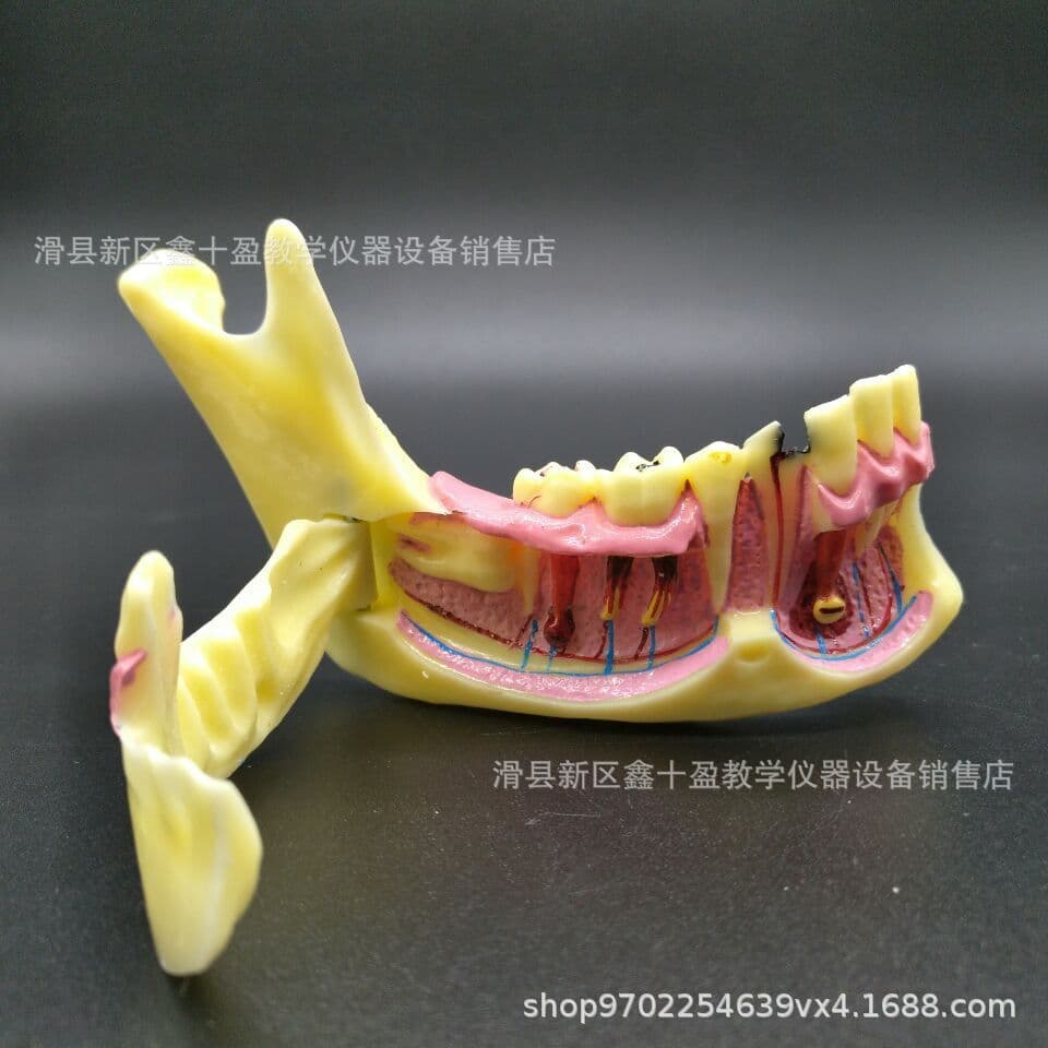 Dental Mandible Decomposition Model Openable to Expose Subgingival Tissue Caries Pathology Display Nerve Model