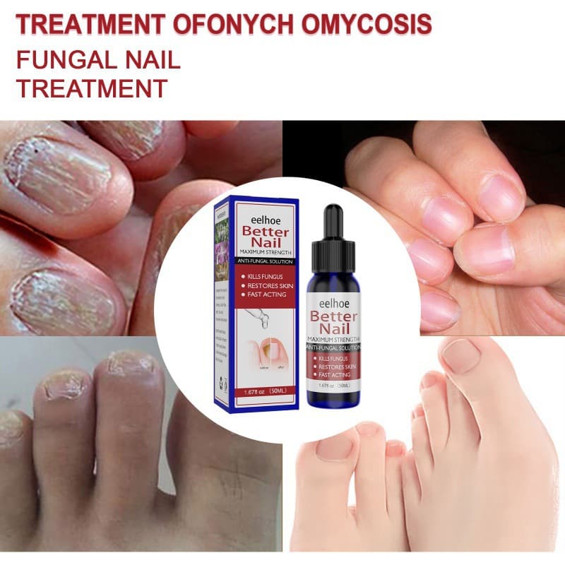 eelhoe Nail Repair Solution for nail care, moisturizing, cleaning, and treating onychomycosis.