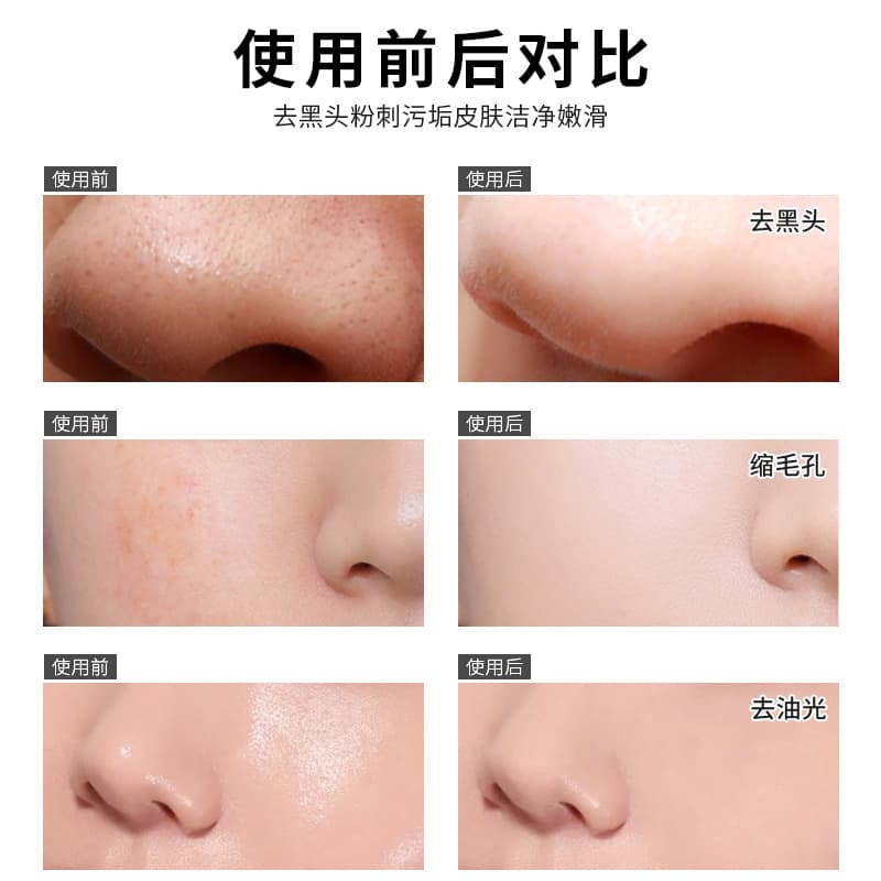 Jinniya Blackhead Removal Nose Mask 6g, Men and Women Blackhead Cleanse Acne Peel-Off Mask 30g, Factory Wholesale