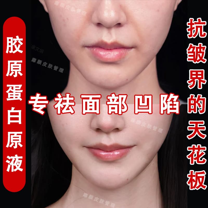 Type III Recombinant Collagen Serum for Filling Depressions, Lifting, Tightening, and Anti-Wrinkle Treatment for Nasolabial Folds, Salon-Grade Anti-Aging Essence