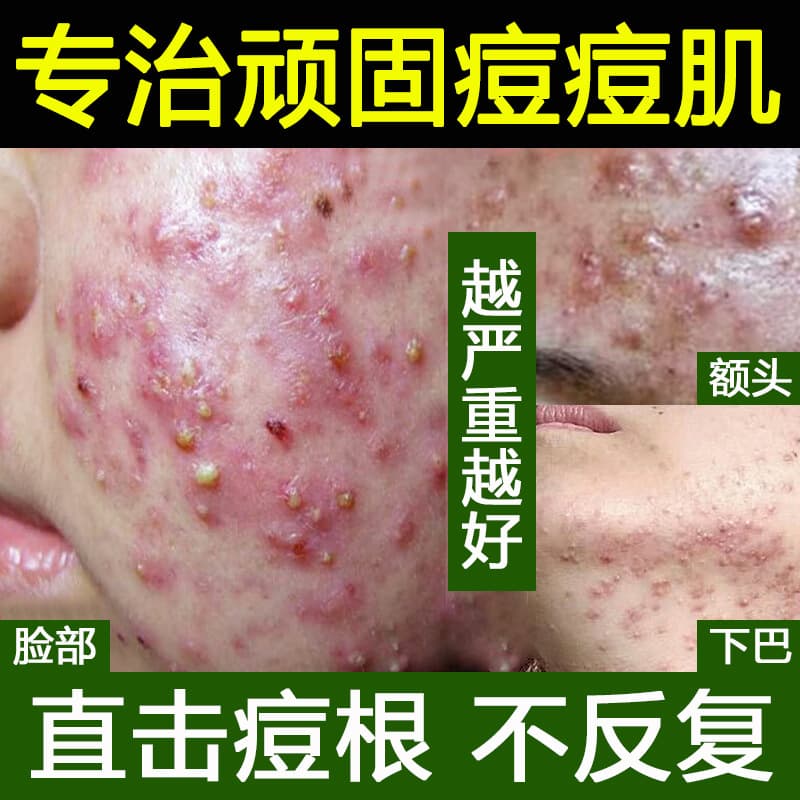 Herbal Anti-Acne Essence Fades Acne Marks, Closes Acne, Shrinks Pores, Beauty Salon Salicylic Acid Anti-Acne Water