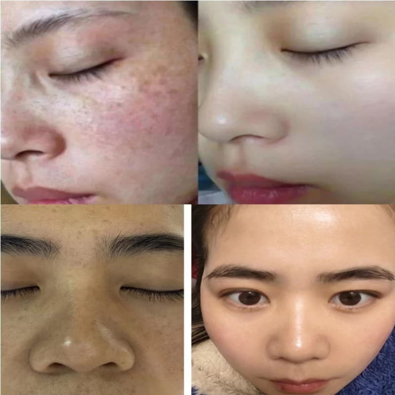 Beauty salon exclusive spot removal cream to block pigmentation and remove freckles, melasma, whiten and brighten skin, spot repair treatment.