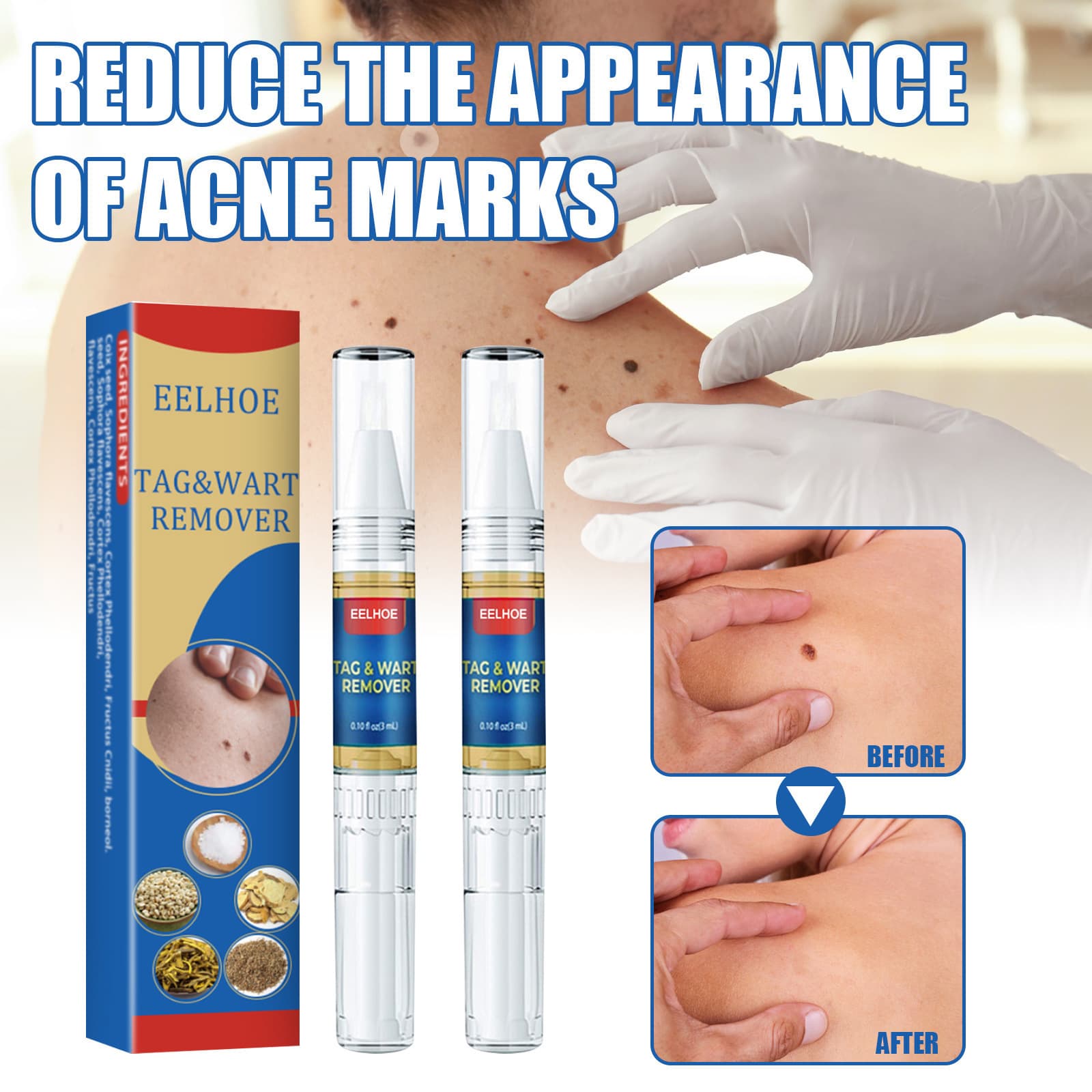 EELHOE Skin Wart Removal Pen Body Skin Tags Wart Removal Liquid Care Skin Repair Care Liquid