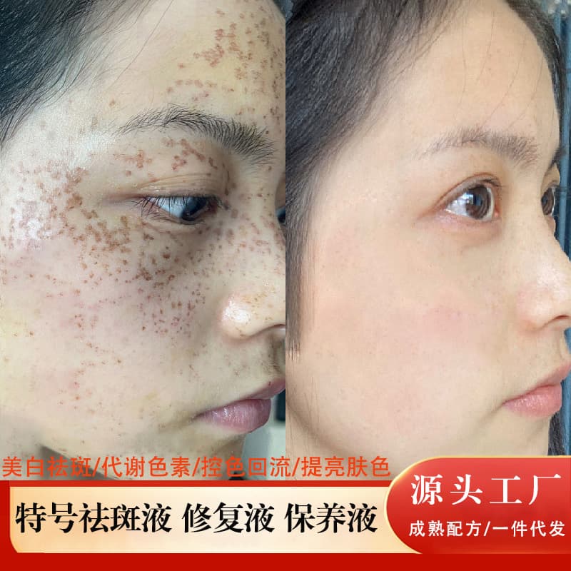 Special Spot Removal Liquid & Color Discharge Liquid for Whitening, Spot Removal, Brightening Skin Tone, Repair Liquid, Maintenance Liquid, Skin Toning Liquid, Whitening Essence