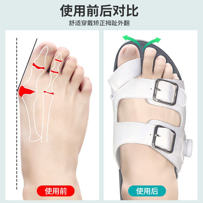 3D Molded Hallux Valgus Correction Sandal for Big Toe Alignment, Bunion Corrector, Flat Foot Support Summer Slippers
