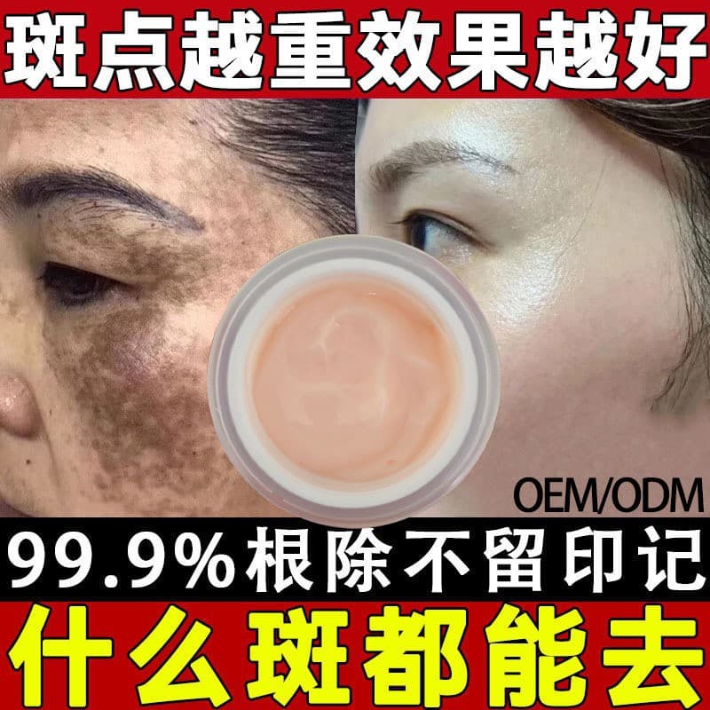 Whitening and freckle-removing cream, highly effective whitening face cream, fades age spots, freckles, and melasma. In stock, fast shipping.
