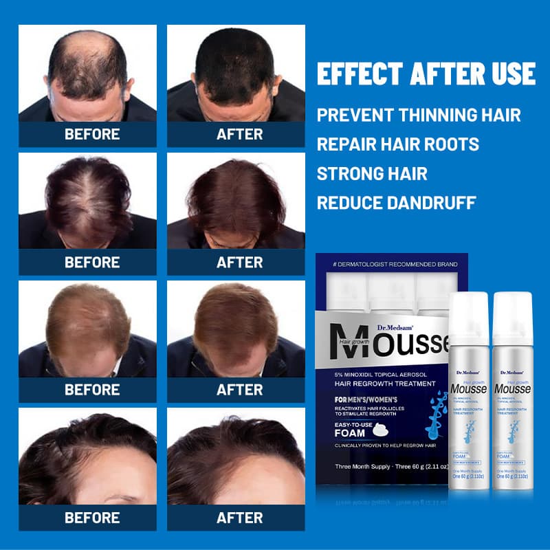 Amazon Minoxidil Hair Growth Foam Mousse Hair Regrowth Spray