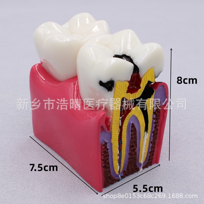 6x Dental Model For Caries Comparison Oral Teaching Dental Education Equipment Tooth Model For Study Teaching