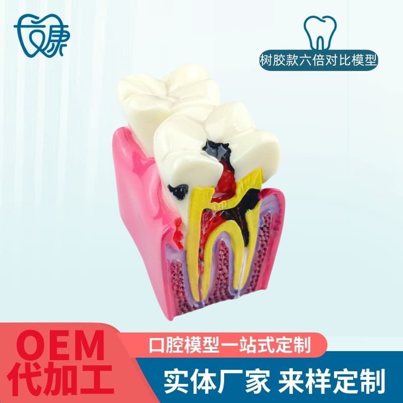 6x Caries Comparison Model Dental Teaching Aid 6x Caries Comparison Model Oral Model Teaching Tooth Model