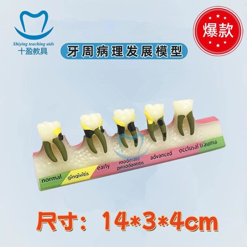 Oral Teeth Model, Periodontal Disease Classification Model, Periodontitis Tartar Evolution Explanation Model