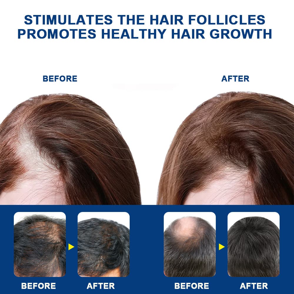 Sumifun Cross-border Amazon Alopecia Areata Cream Scalp Skin Care Hair Treatment Cream Manufacturer Stock
