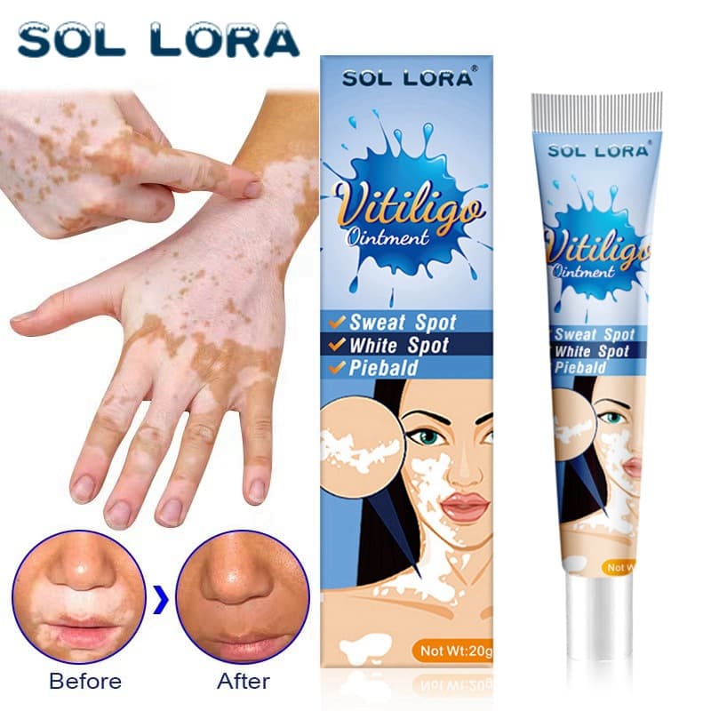 SOL LORA Cross-border Vitiligo Care Cream White Spot Clearing Ointment for Tinea Versicolor, Sweat Spots, Vitiligo Skin External Use Ointment