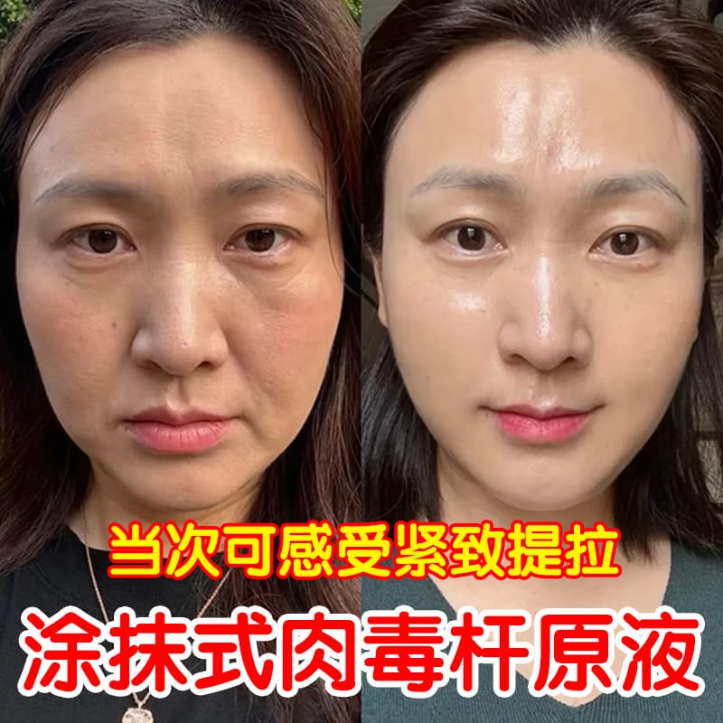Topical Botulinum Toxin Serum for Nasolabial Folds, Forehead Lines, Fine Lines, Wrinkle-Reducing, Firming, Anti-Wrinkle Essence
