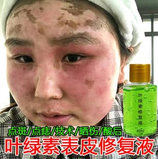 Epidermal Repair Liquid, Thicken Stratum Corneum, Post-Spot Removal Redness, Facial Pain and Itching, Hormone Face Redness Repair Liquid