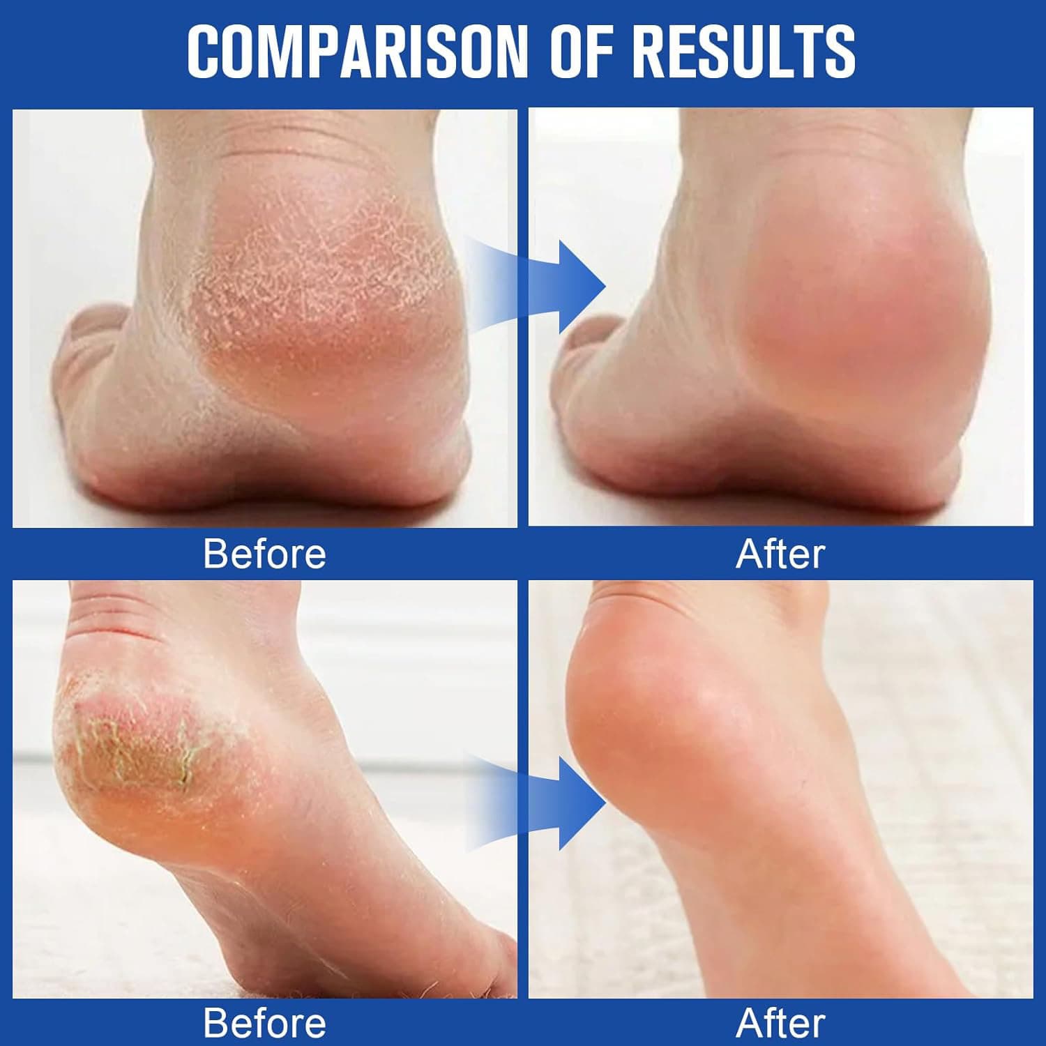 TK Cross-Border Best-Selling Salicylic Acid Urea Hand and Foot Care Stick, Anti-Cracking, Moisturizing, and Hydrating for Autumn and Winter