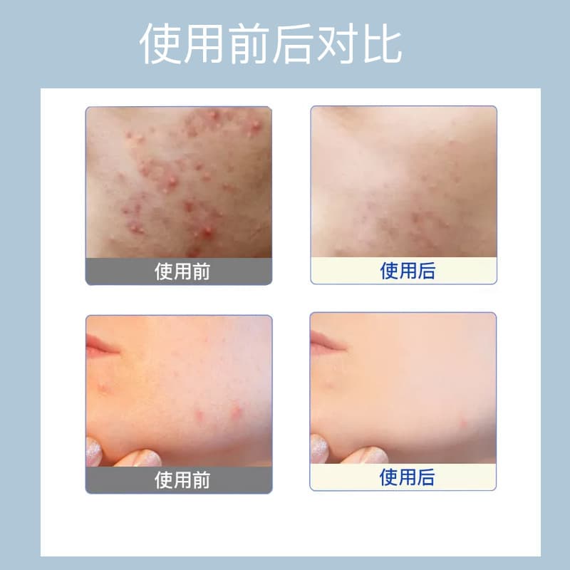 Beauty Salon Oligopeptide Lyophilized Powder Repair Acne Scars Bare Bottle Factory Wholesale Paid Sample Repair Moisturizing