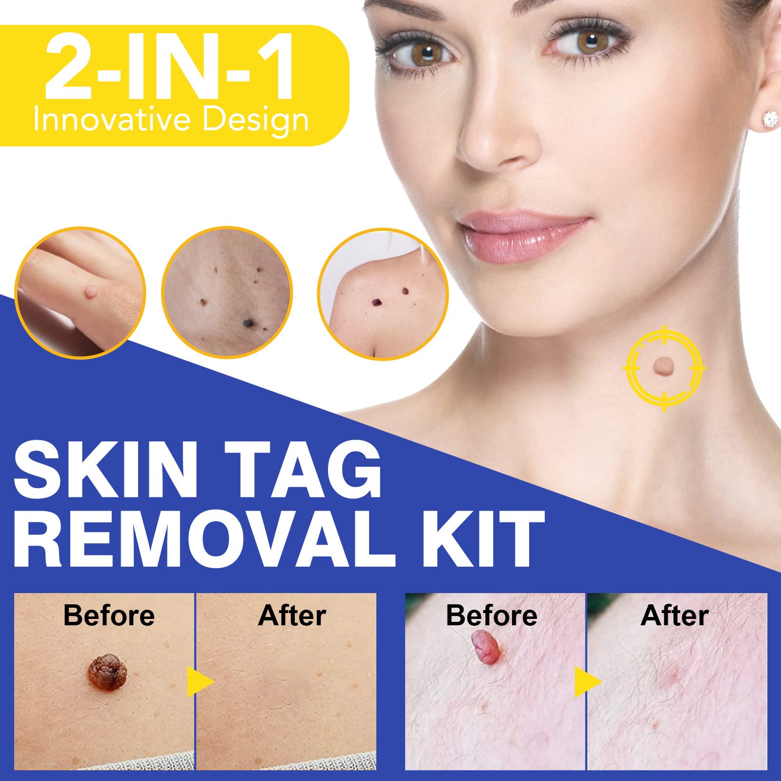ELAIMEI Simple Wart Removal Skin Tool Skin Tag Removal Kit