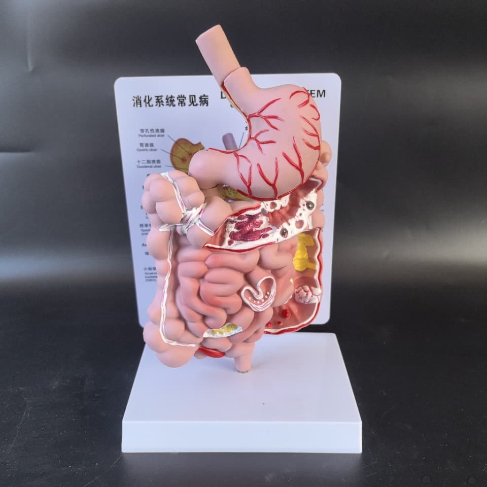 Human Digestive System Stomach, Pathological Perforated Stomach Ulcer Intestinal Pathology Lesions Large Intestine Cecum Duodenum Teaching