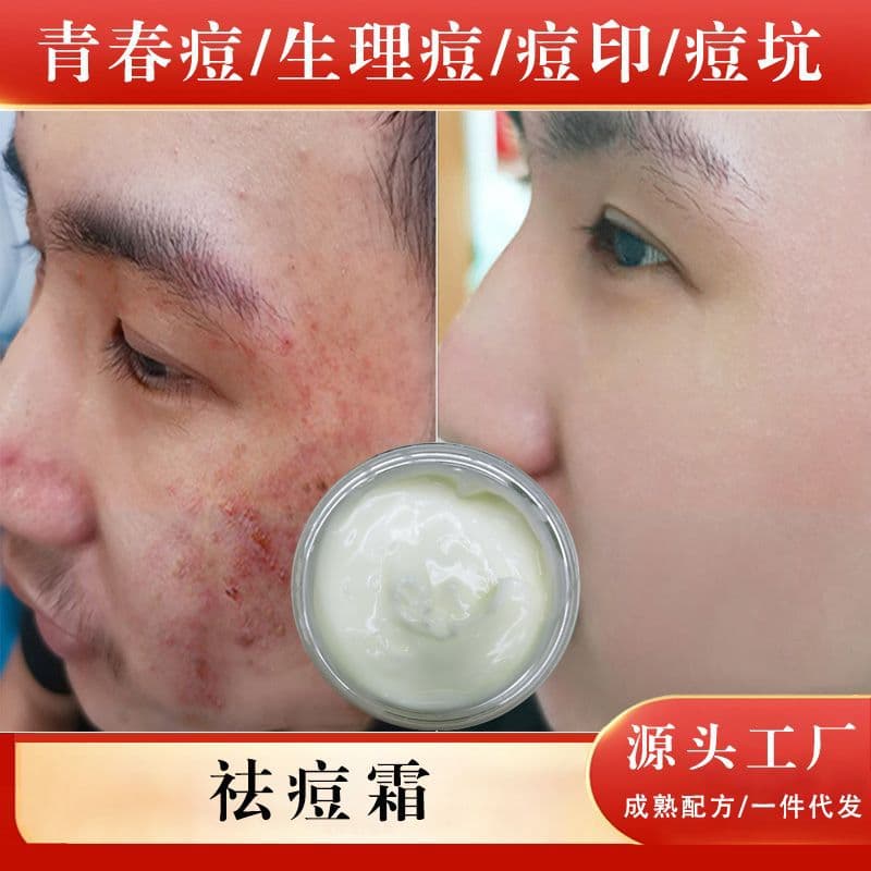 Herbal Premium Acne Cream for Acne, Blackheads, and Closed Comedones, Gentle Fading of Acne Scars and Pits, Unisex Acne Treatment Cream