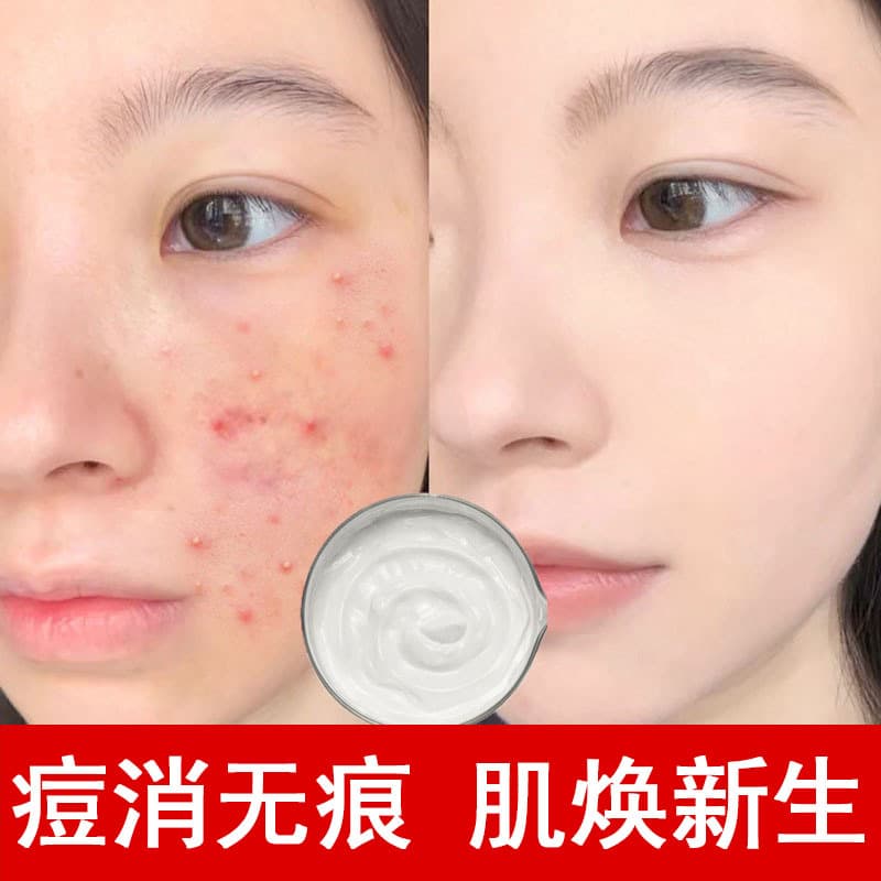 Acne Cream - Fade Acne Scars, Closed Comedones, Pimples, Repair Acne Scars, Herbal Acne Cream for Salon Wholesale