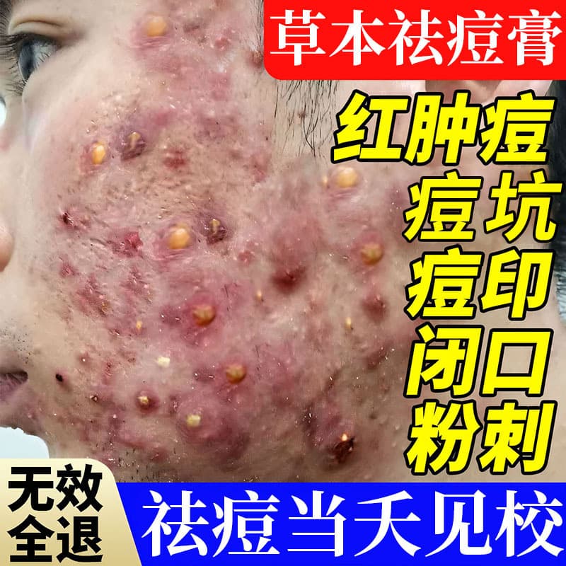Herbal Acne Cream for fading acne marks, scars, teenage acne, blackheads, whiteheads, improving closed comedones, and pitted acne scars