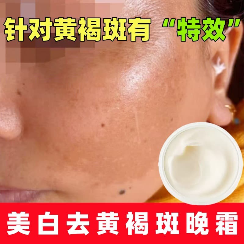 Melasma Cream Whitening Spot Removal No Redness No Swelling No Peeling Inhibits Melanin Improves Dull Skin Whitening Spot Removal Cream