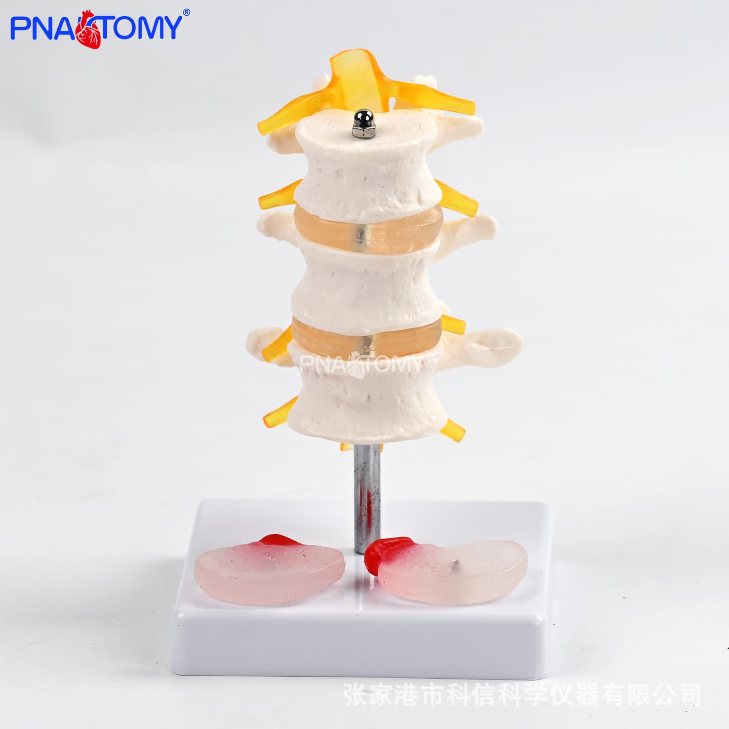 Medical Three-Section Lumbar Belt Diseased Intervertebral Disc Model Herniated Bulging Degenerated Nerve Root Compression Teaching Doctor-Patient Communication