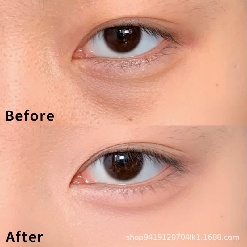 Foreverkey Concealer Pen - Cover Spots, Dark Circles, Acne Scars & Imperfections for Women & Students