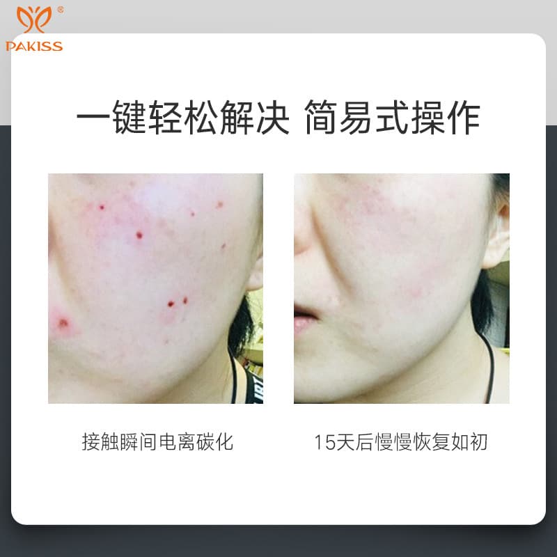 German White Laser Freckle Removal Pen for Beauty Salon Use, Mole and Spot Removal Beauty Device