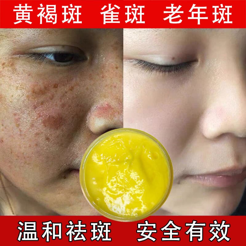 Astragalus Cream Autumn Winter Moisturizing Brightening Lifting Day Cream Night Cream Fade Melasma Lighten Yellow Spots Whitening Spot Control Cream