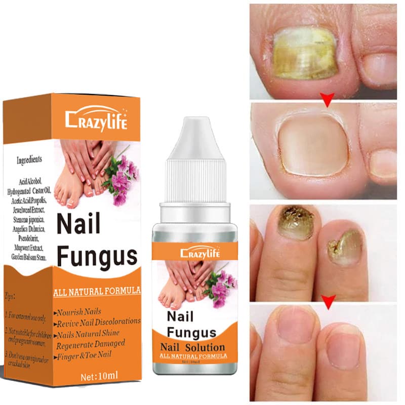 Crazylife Hand & Foot Care Solution & Nail Care Solution 10ml & Nail Fungus 10ml