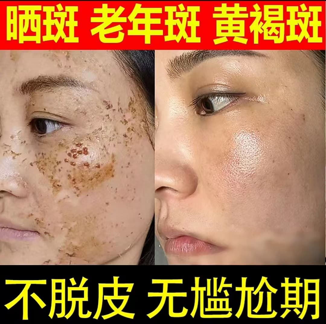 Freckle Removal Cream for Dark Spots, Age Spots, Melasma, Fading Freckles, Official Authentic Whitening Spot Removal Cream