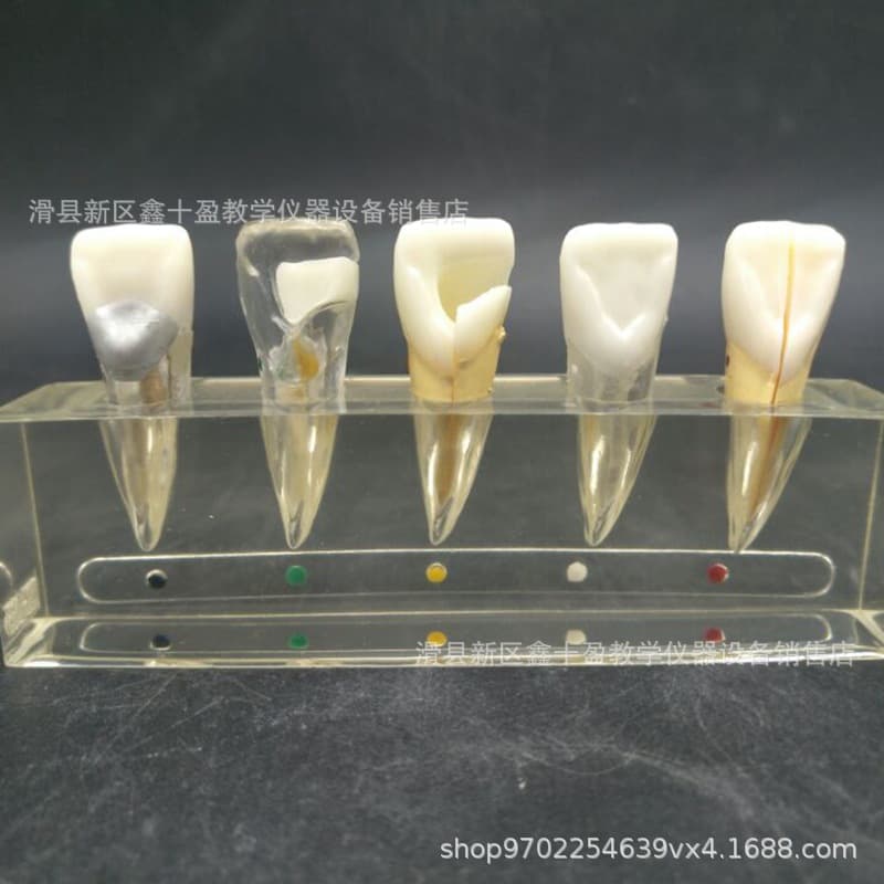 Dentistry, incisor root canal model, diseased pulp repair model, carious crown nerve removal, filling and restoration