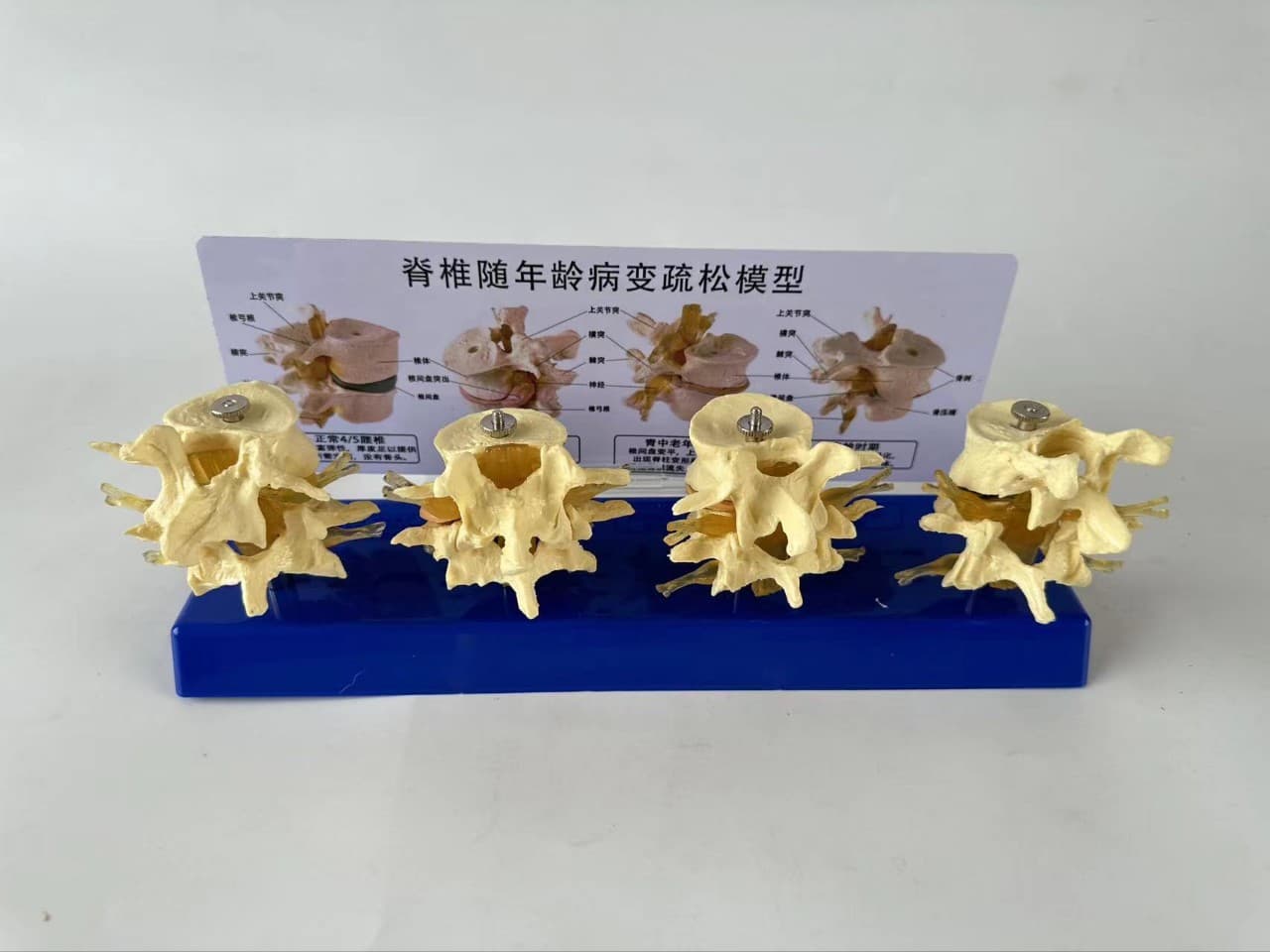 Human lumbar spine changes with age, osteoporosis, intervertebral disc atrophy, nerves, spine, skeleton