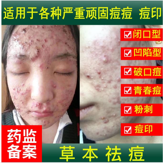 Herbal Acne Cream for Men and Women, Acne Scar Fading, Pimple Removal Cream, Factory Direct Supply