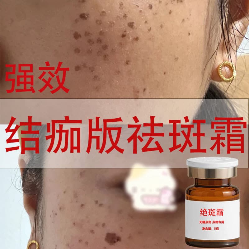 Clinic-grade freckle-removing cream, spot-removing cream, freckle-removing cream, painless and highly effective freckle and spot-removing cream.