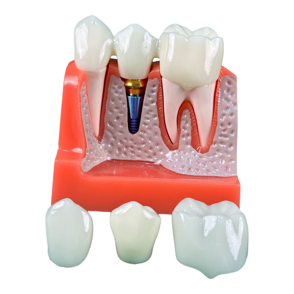 Production of dental models for medical teaching and dental student practice; 4x larger implant demonstration model A