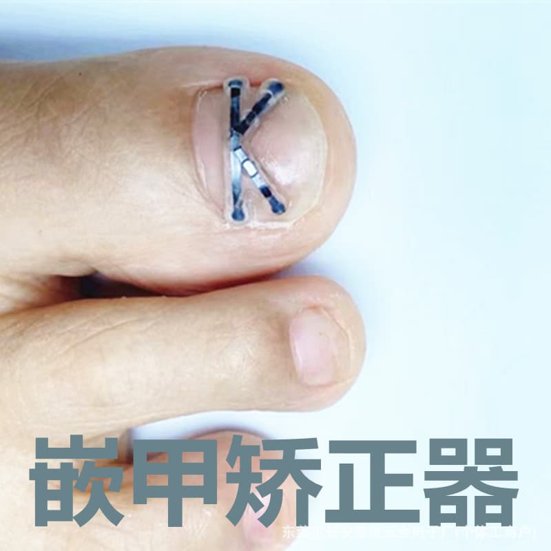 New Ingrown Toenail Patch Nail Correction Device Nickel-Titanium Alloy Ingrown Toenail Correction Patch Wholesale
