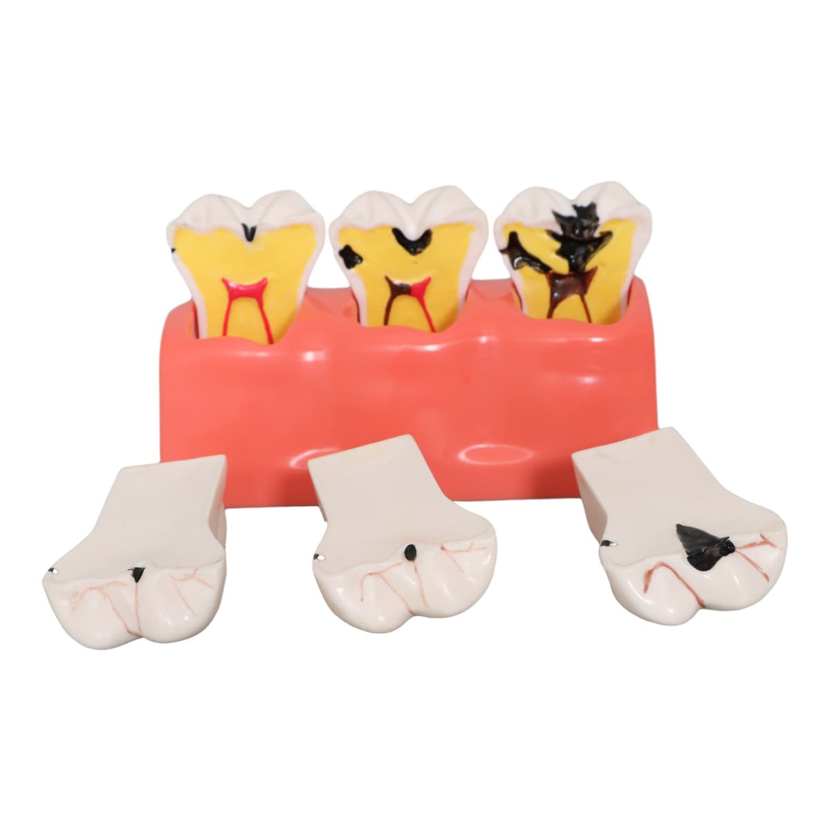 Dental Model - Tooth Caries Evolution Model, Patient Communication Model, 3-Stage Fourfold Caries Breakdown Model