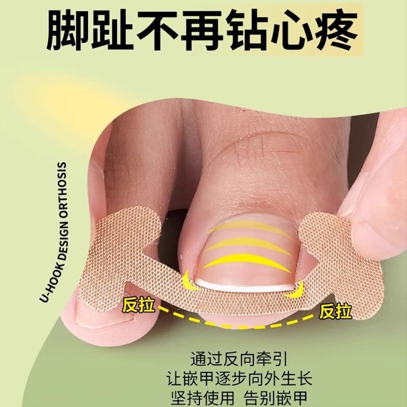 No-Glue Nail Correction Patch for Ingrown Toenails, Toenail Sticker, Nail Care, Factory Supply
