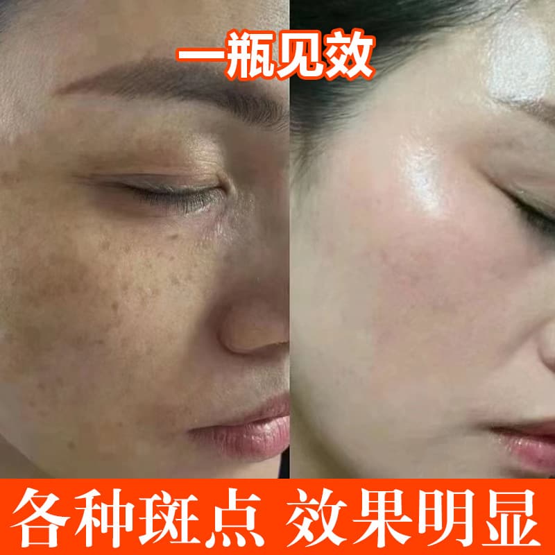 Non-invasive Melasma Dissolving Serum Breaks Down Melanin Lightens Dark Spots Beauty Salon Freckle Sun Spot Melasma Removal Serum