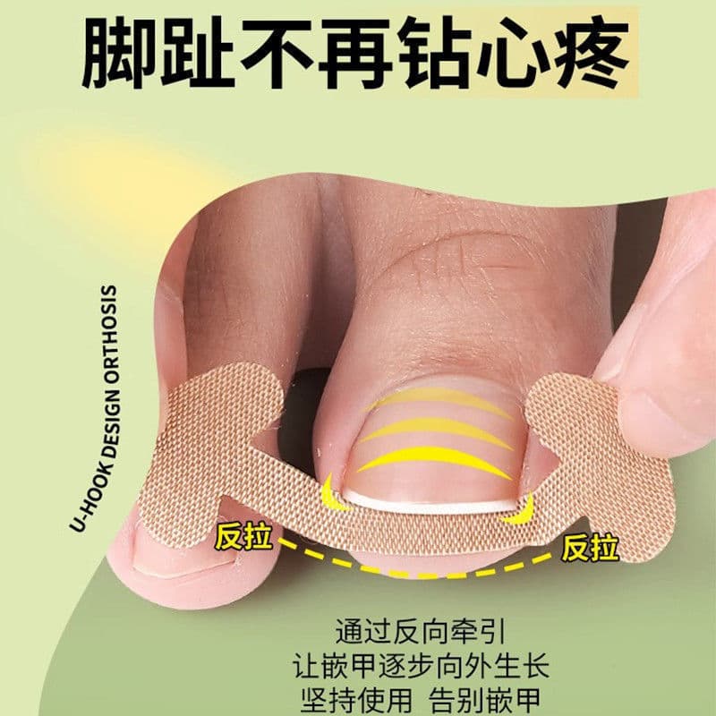Glue-free nail patch nail groove ingrown toenail corrector toenail toenail patch pulling and manicure factory goods