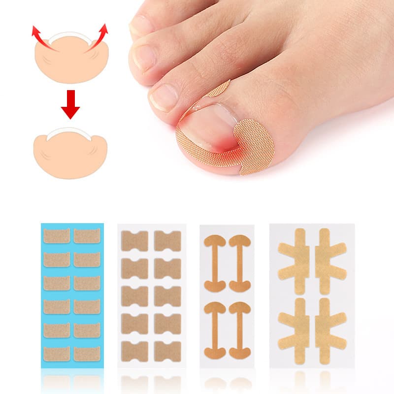Self-Adhesive Elastic Toenail Correction Patch Nail Repair Ingrown Toenail Corrector Orthopedic Nail Clip Puller